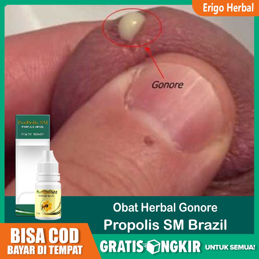 Obat Gonore Spilis Raja Singa Kencing Nanah Kutil Kelamin Herbal Propolis Sm Di Tengerang Shopee Indonesia