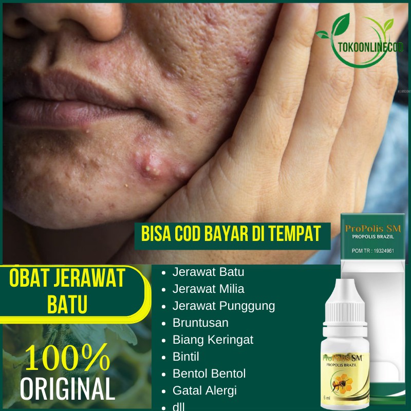 Obat Jerawat Batu - Penghilang Jerawat Batu - Jerawat Punggung - Jerawat Badan - Jerawat Pria Wanita