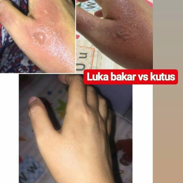 Minyak Kutus Kutus Untuk Luka Bakar Shopee Indonesia