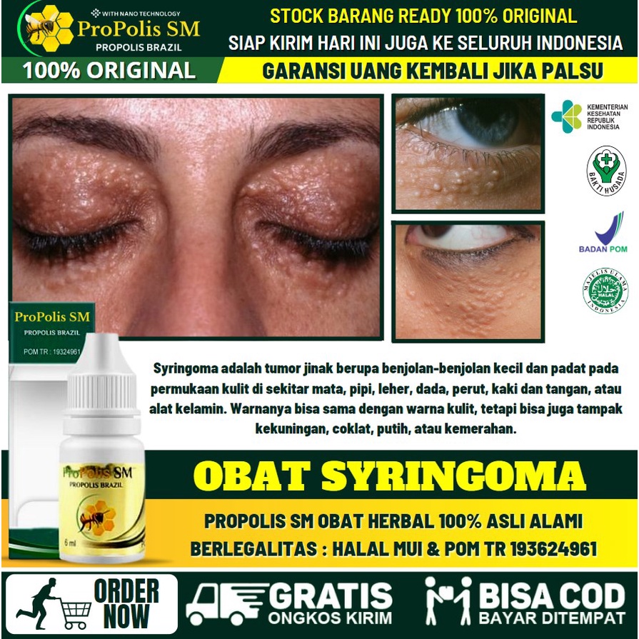 Salep Alami Penghilang Syringoma Aman Bpom, Obat Benjolan Kecil Tumor Jinak di Kelopak Mata / Pipi /