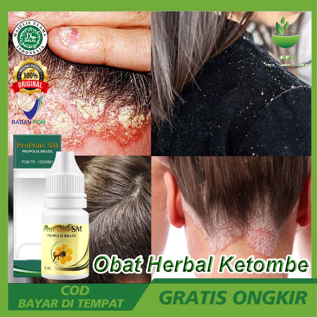 Obat Herbal Perontok Ketombe Ampuh Membandel Penghilang Ketombe Menghilangkan Ketombe Dengan Cepat K