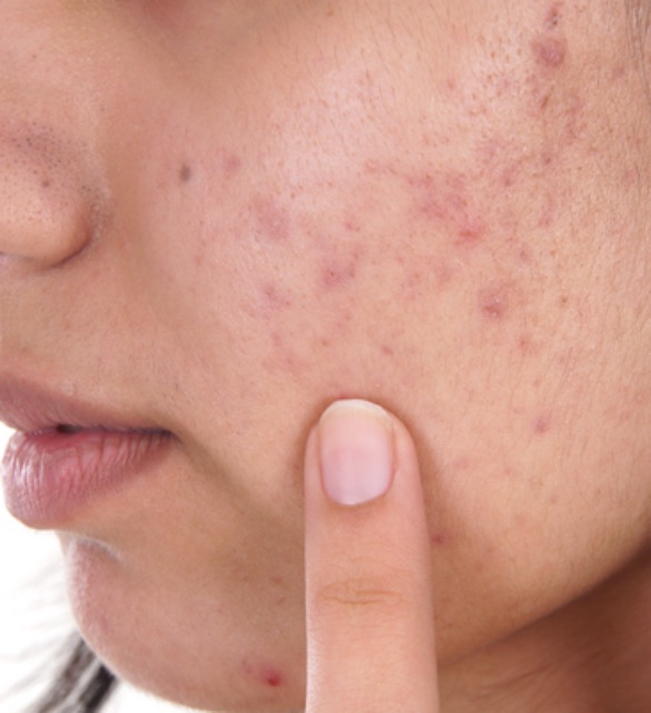 Collagen + Vit C Serum Aknèlab 20ml (brightening skin serum)