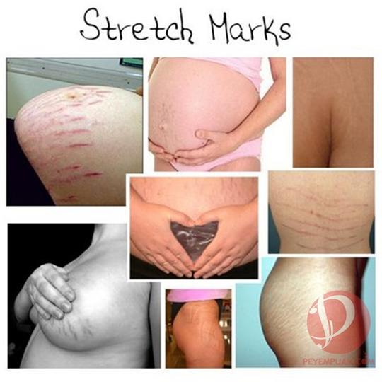 [COD] Krim Ampuh Penghilang Stretch Marks - Laoshiya Cream 40ml ORIGINAL BPOM Menyamarkan atau Menghilangkan Stretch Marks Garis Halus Pasca Melahirkan Penurunan serta Kenaikan Berat Badan