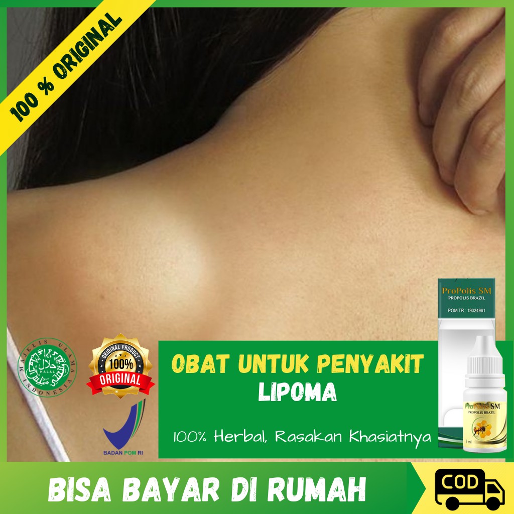 Obat Lipoma Oles Benjolan Di Leher - Lipoma Lemak - Penghancur Lipoma Alami Propolis SM Asli