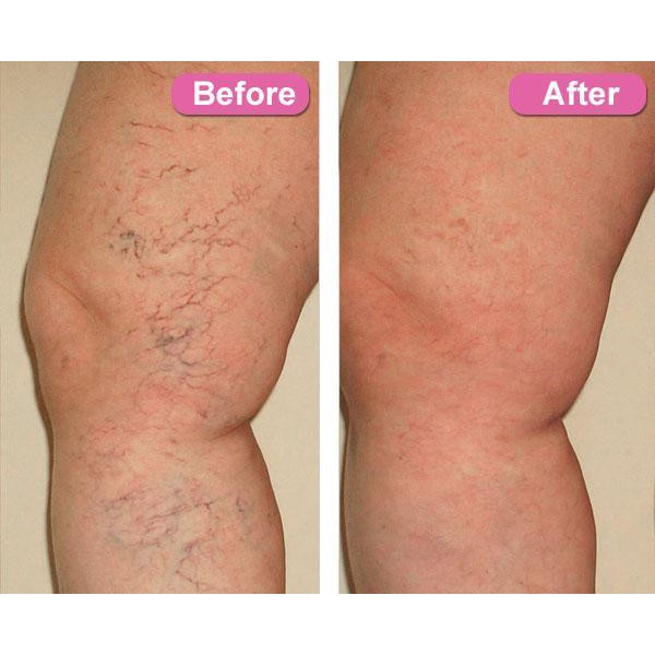 Varicose Veins Treatment Cream / Salep Penghilang Varises