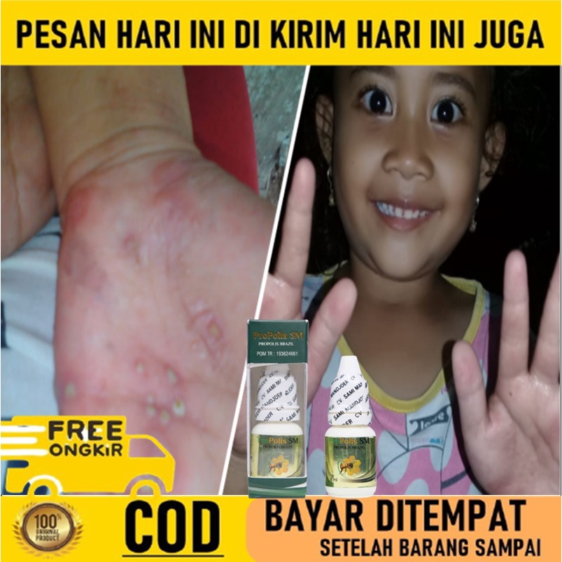 Obat budug bernanah - Salep budug - Obat Gatal kulit - Obat Jamur kulit - Obat Scabies manusia - Oba