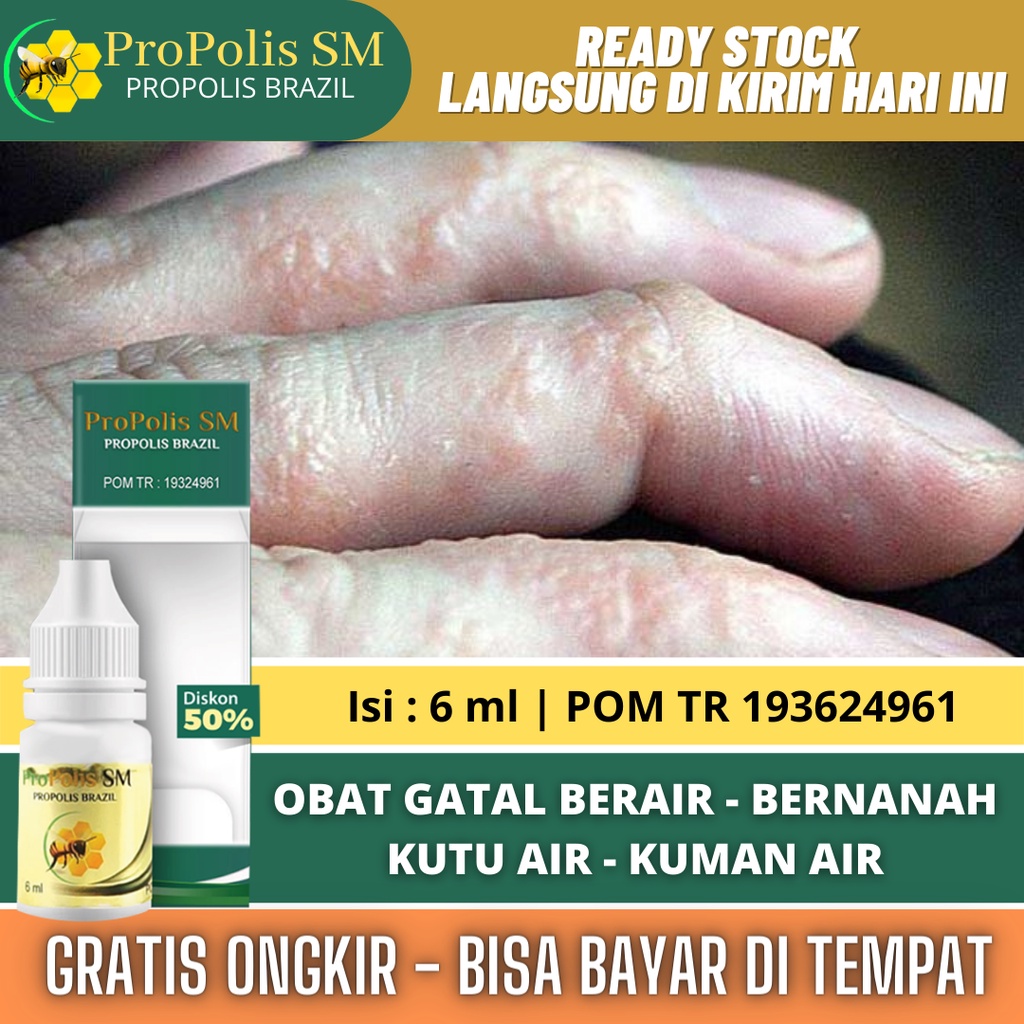 Jual Obat Gatal Berair Di Jari Tangan Dan Kaki Gatal Bintik Berair Gatal Di Sela Sela Jari 9237