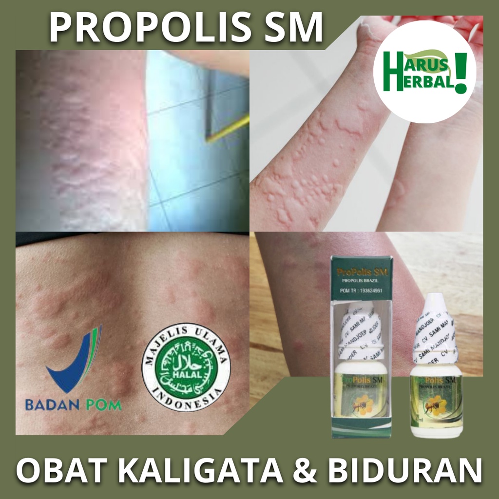 Obat Mengatasi Kaligata/Biduran Dengan PROPOLIS SM,Obat Oles Kaligata,Obat Gatal Kaligata/Biduran, K
