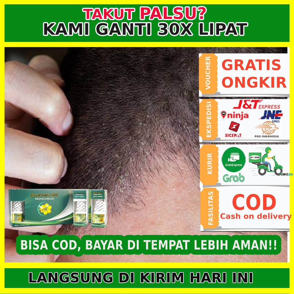 Obat Menghilangkan Ketombe/ Ketombean/ Ketombe Berkerak - Propolis SM Original - Propolis Brazil