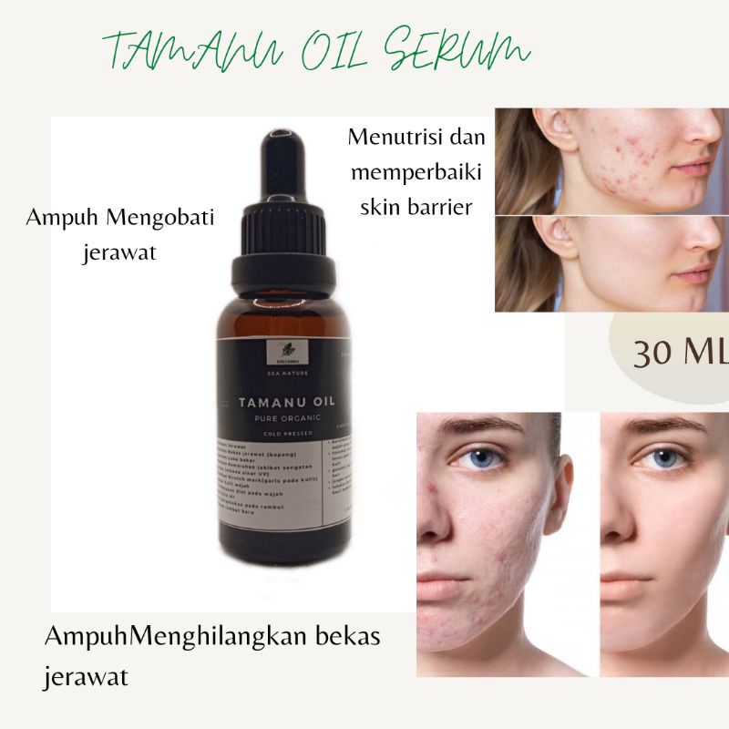 TAMANU OIL/ FACE OIL/ obat penghilang jerawat /penghilang bekas jerawat (bopeng)/ penghilang stretchmarks/ penghilang bekas luka/ penghilang eksim kutu air SEA NATURE BY SHEVANNA