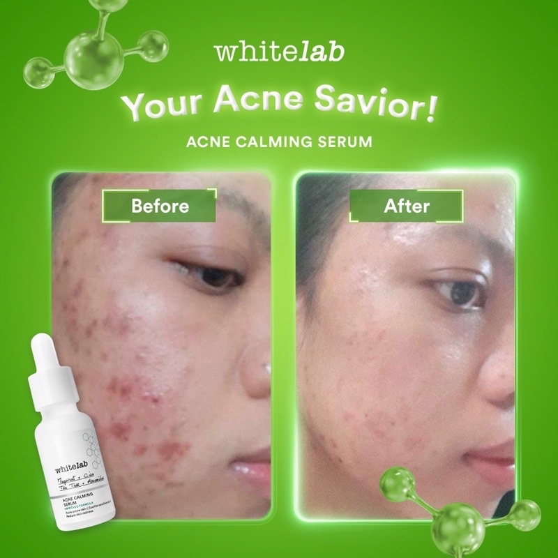 Whitelab Acne Calming Serum Improve Formula - Whitelab Surabaya