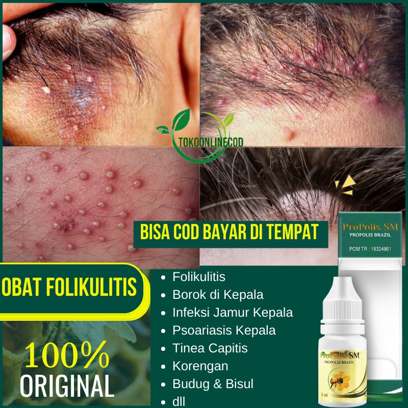 Jual Obat Folikulitis Folikulitis Kepala Folikel Rambut Benjolan Kecil Pioderma Karbunkel 