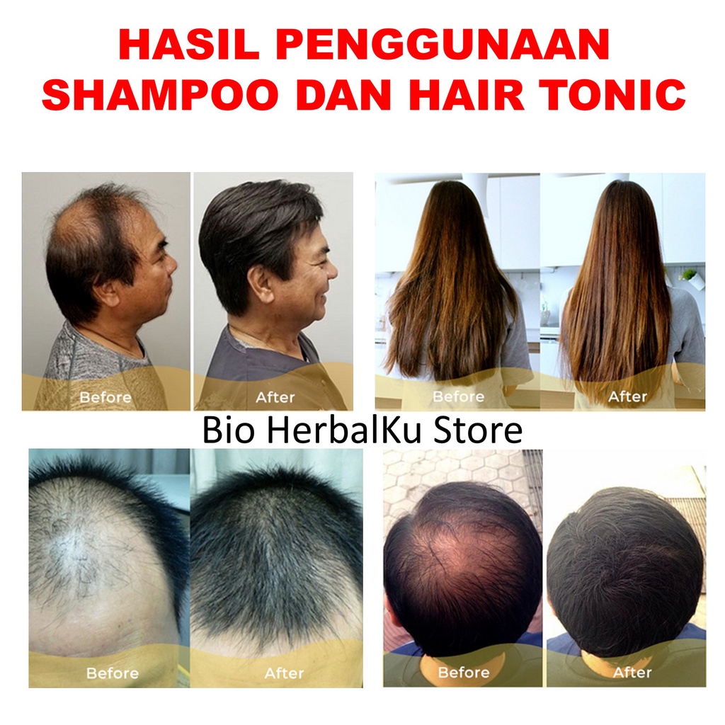 Obat Rambut Rontok Paket Sampo Rambut Rontok Dan Hair Tonik Rambut Rontok Penyubur Rambut Rontok B3C-4