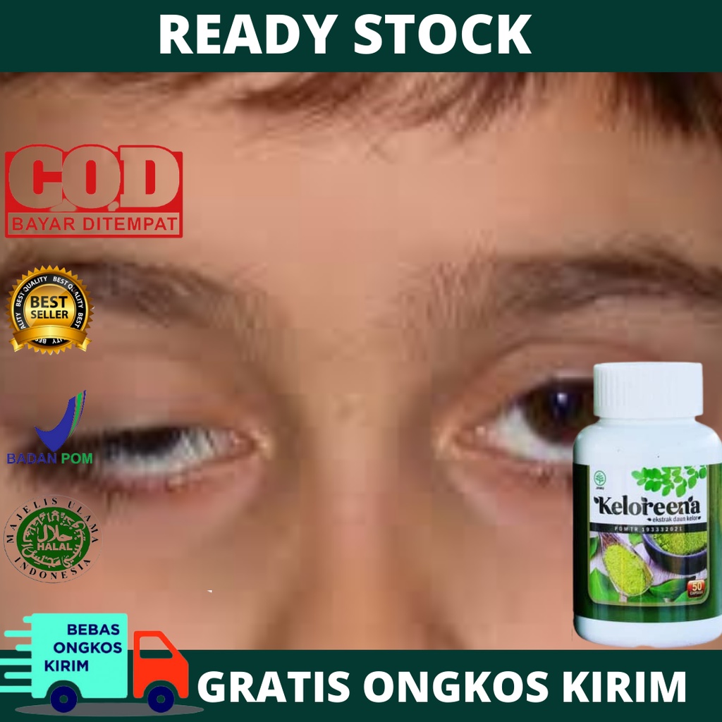 Obat Kelopak Mata Turun Sebelah, Mata Sipit Sebelah Bukan Dari Lahir, Saraf Mata Lemah, Mata Ptosis