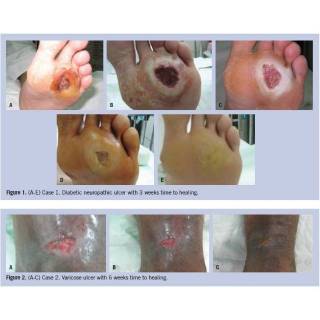 Obat Diabetes Herbal Luka