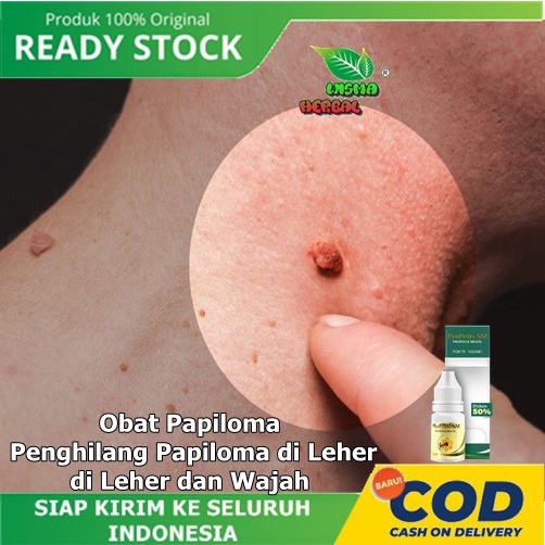 Obat Papiloma, Penghilang Papiloma di Leher, di Leher dan Wajah, Menghilangkan Kutil di Leher, Peron