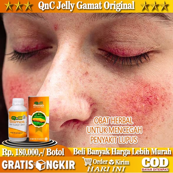 Jual Obat Pencegah Penyakit Lupus Herbal, Obat Alami untuk Penyakit