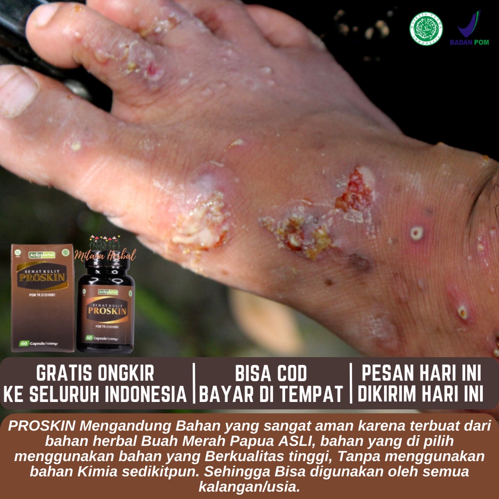 Obat budug