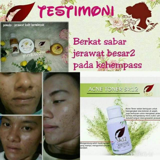 Acne Toner SR12/ Toner jerawat/ obat jerawat ampuh/ jerawat/ bruntusan/ bruntus/ jerawat kecil kecil