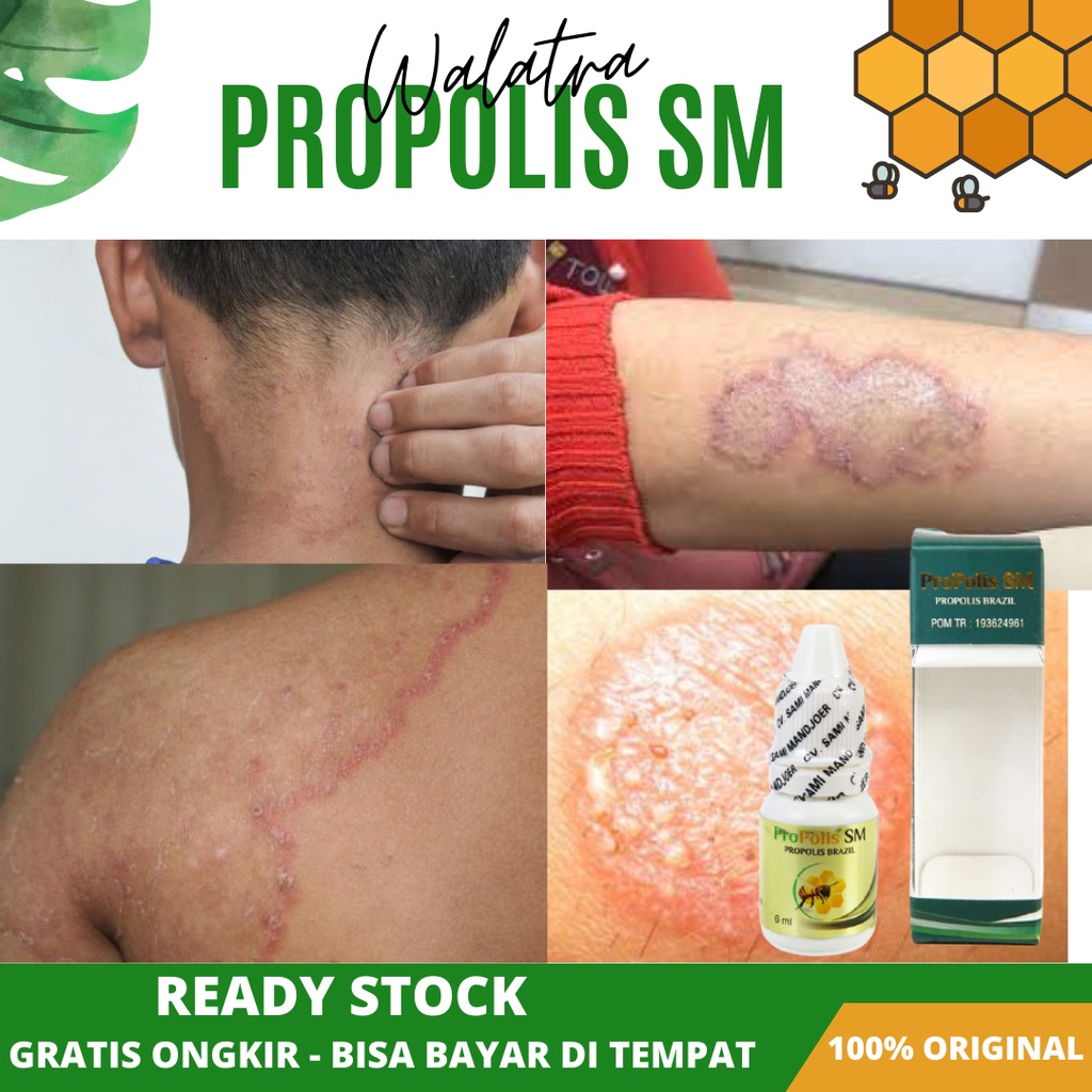 Jual Propolis Sm Obat Oles Kurap Gatal Di Selangkangan Tangan Leher Punggung Kaki Obat