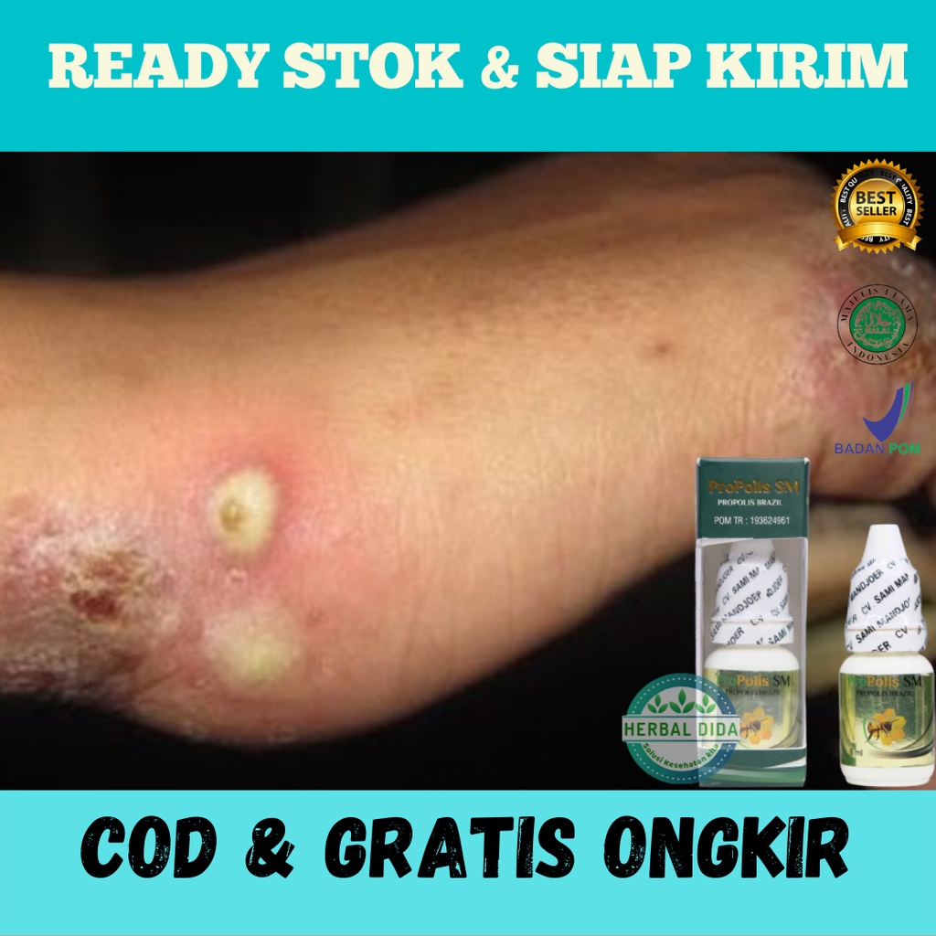 PROPOLIS SM 100% ORIGINAL BPOM, Obat Herbal Budug Menahun, Obat Kulit Gatal, Obat Herbal Jamur Kulit