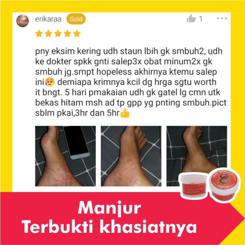 Salep Obat Gatal Paling Ampuh Kulit Gatel Eksim Kering Selangkangan Kurap Kudis Basah Jamur Kutu Air-2