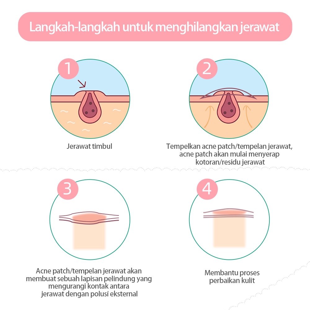 LANBENA Acne Pimple Patch Masker Treatment Stiker Jerawat Wajah Komedo Skincare Eliminate Redness In Korea