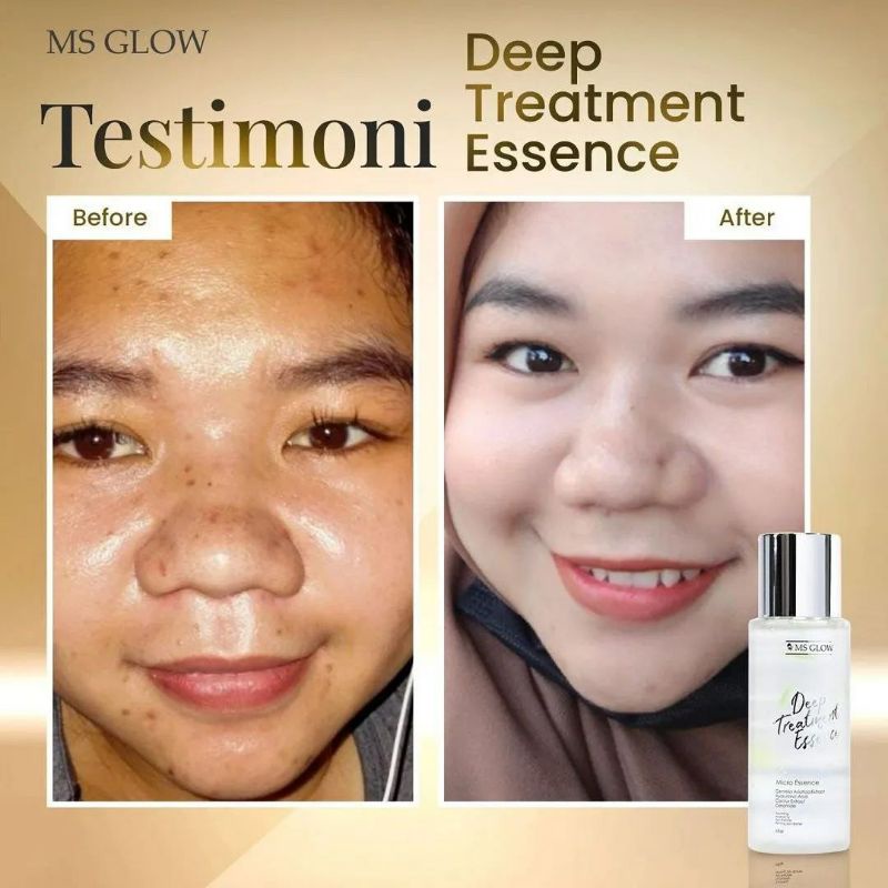 MS GLOW DTE (DEEP TREATMENT ESSENCE) UKURAN MINI MS GLOW