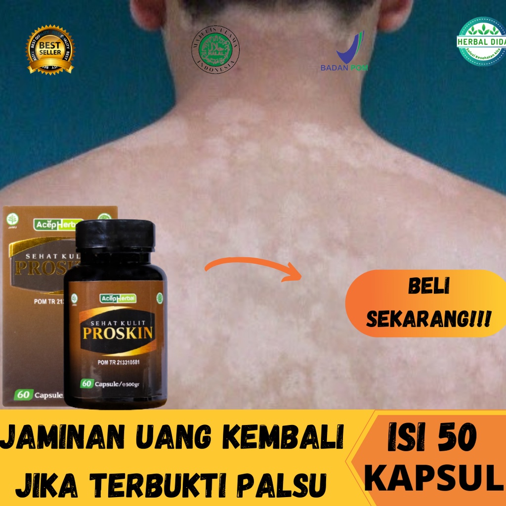 PROSKIN 100% ORIGINAL BPOM, Obat Jamur Kulit Gatal Gatal Panu, Obat Kulit Panu, Obat Anti Panu & Jam