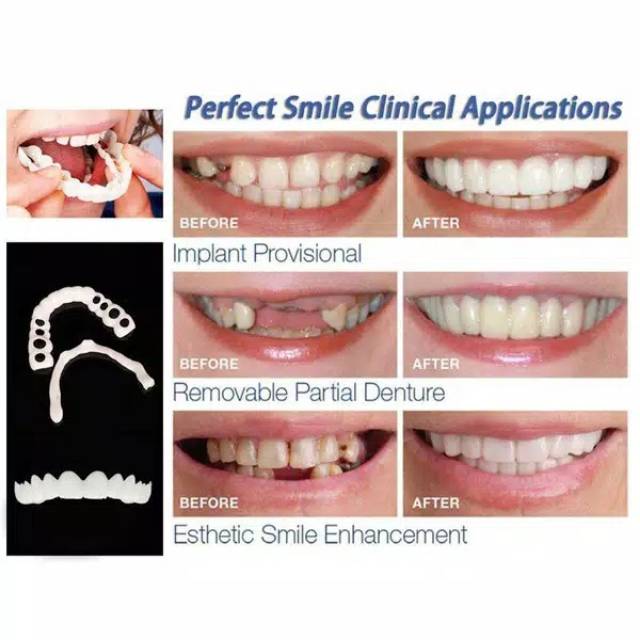 Gigi Palsu Nyaman untuk Memutihkan Gigi tanpa box