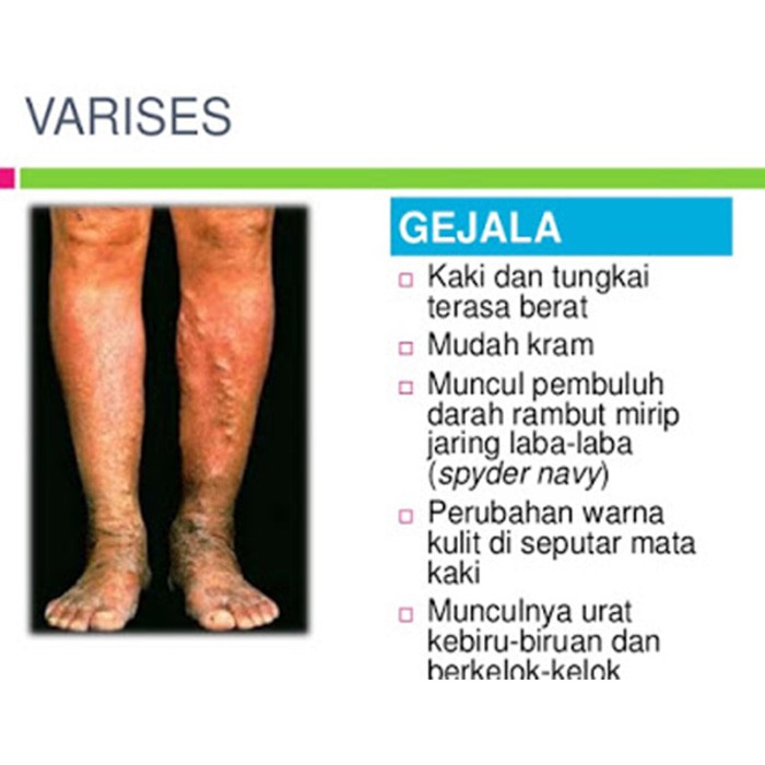 Obat Penghilang Varises Di Kaki Betis Mujarab Gold G Jelly Gamat Shopee Indonesia