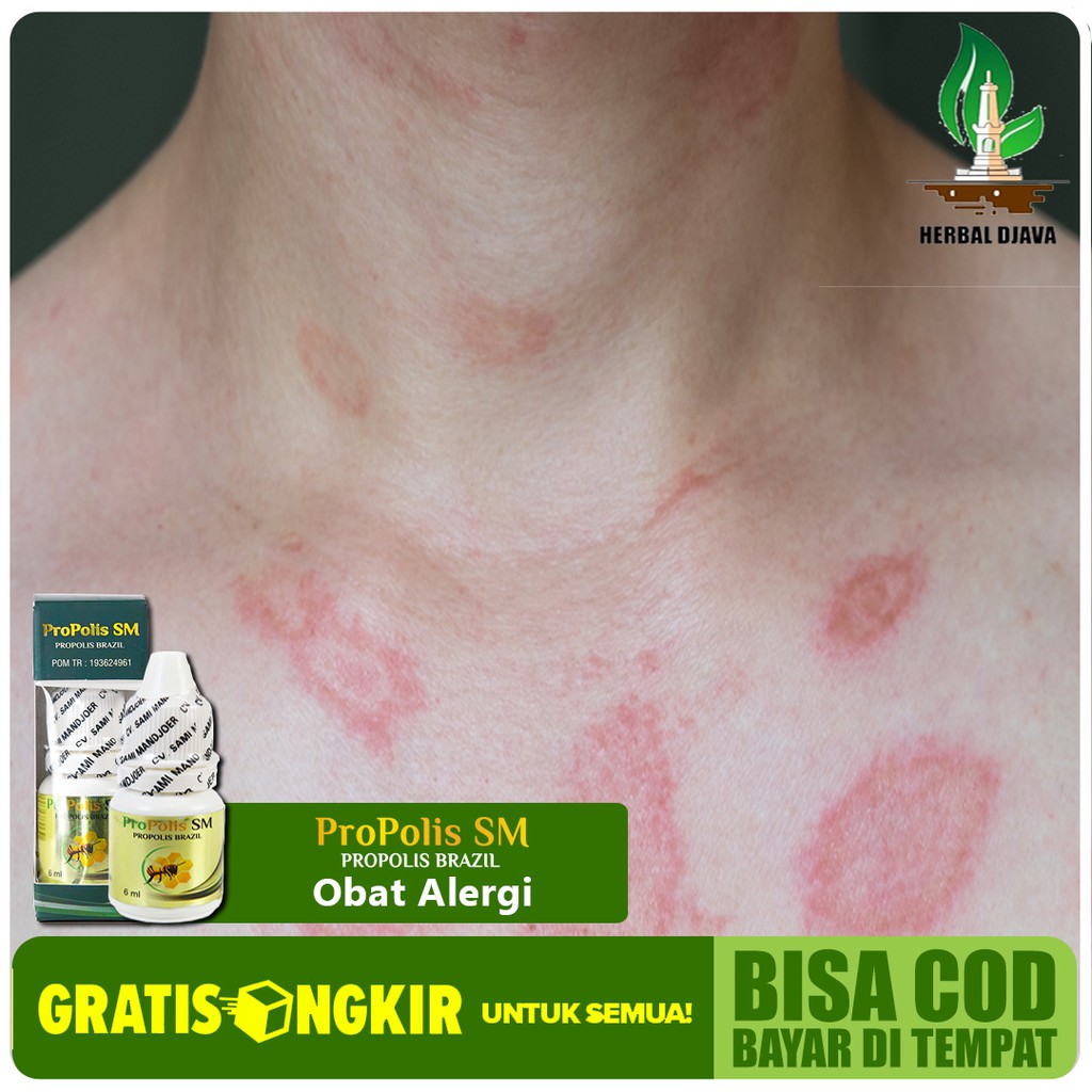 Obat Alergi Badan - Tubuh Gatal Gatal - Di Leher - Tangan - Lengan - Paha - Punggung Propolis SM