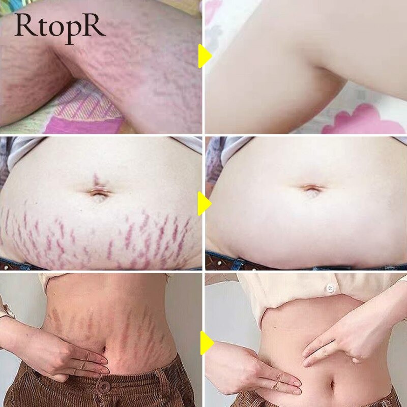 [Terbukti Alami] Rtopr Cream Penghilang Stretch Mark Bekas Luka Kerutan Tubuh Perut Ibu Hamil