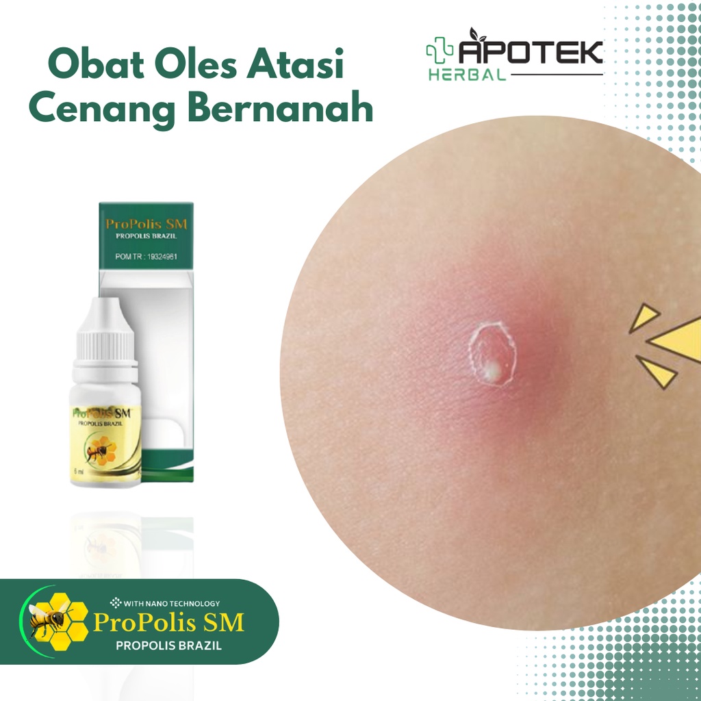 Obat Cenang Bernanah, Obat Oles Bisul Bernanah, Obat Cenang Bernanah Anak, Obat Salep Cenang dan Bis