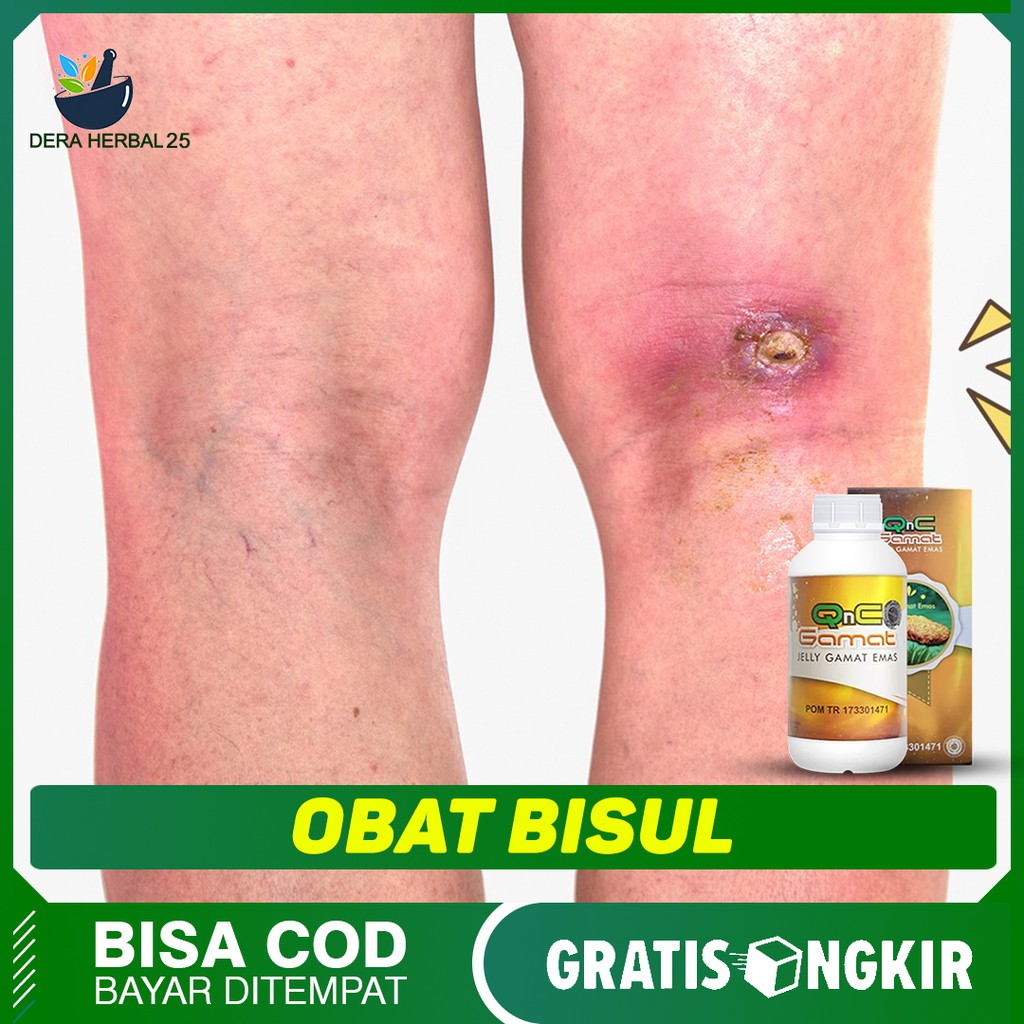 Obat Untuk Bisul Obat Pengering Bekas Bisul Qnc Jelly Gamat Herbal Teripang Original Shopee Indonesia