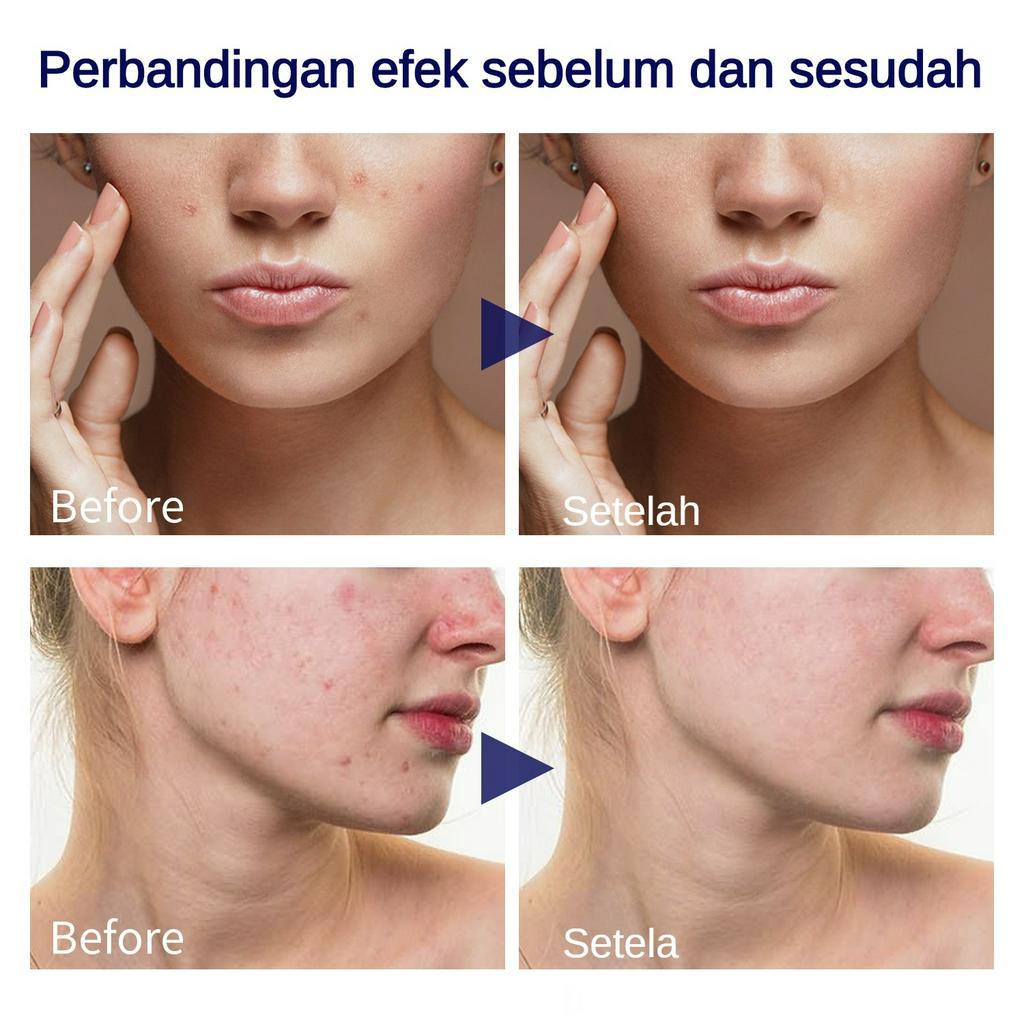 YOUBUY Dark Spots Whitening Face Serum 30ml Hyaluronic Serum Niacinamide Serum Pencerah Wajah Essence