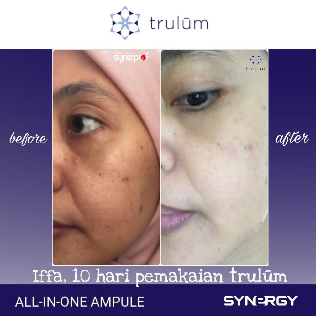 ®294¥ Cream Kecantikan Yang Aman,..Cream Untuk Menghilangkan Flek Hitam Akibat Kosmetik Trulum