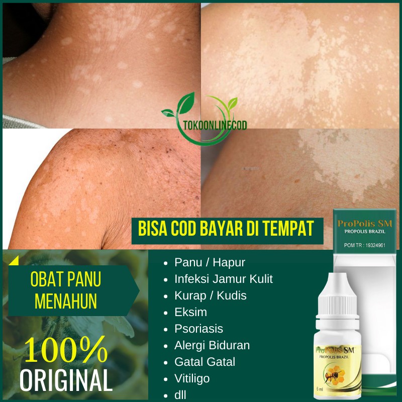 Obat Panu Jamur Kulit di Wajah Tangan & Seluruh Badan Propolis SM