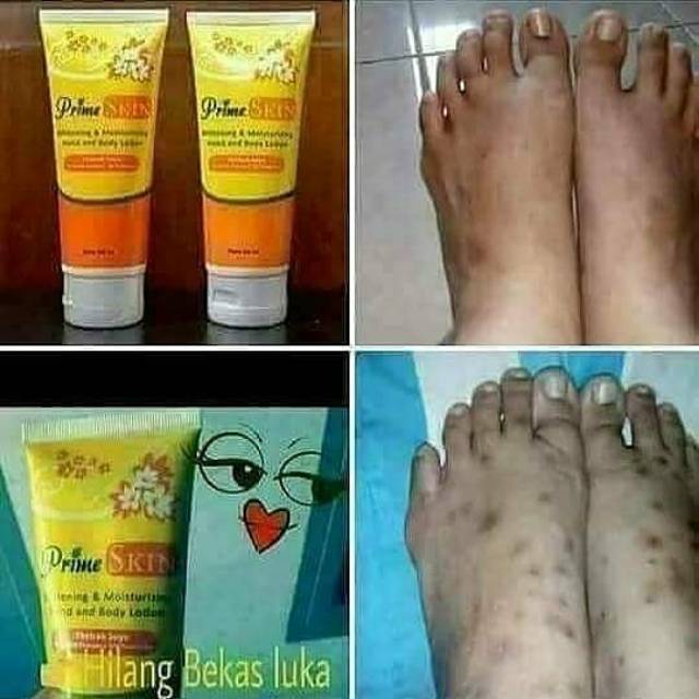 Prime skin lotion ( menghilangkan bekas luka dan cacar)