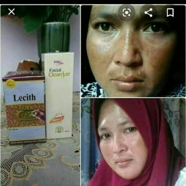 Paket flek membandel