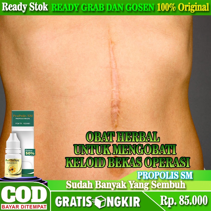 Jual Obat Keloid Bekas Operasi Obat Keloid Obat Keloid Bekas Luka