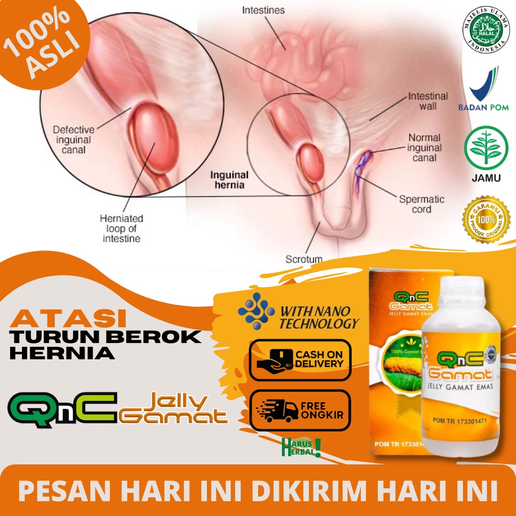 Obat Hernia Alami, Obat Turun Berok Alami, Obat Hidrokel Dan Varikokel, Obat Testis Besar Sebelah, T