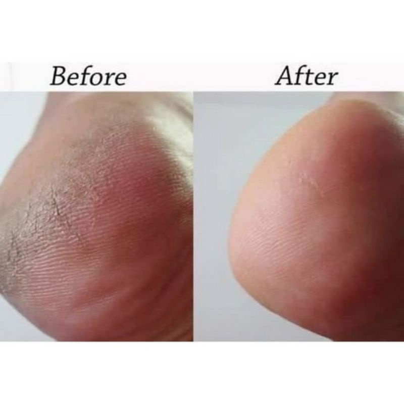 (COD) Tumitku Obat Penghilang Kepalan & Kulit Kaki Pecah-4