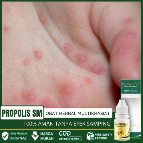 Obat Gatal Bentol Gelembung Pada Anak - Obat Kulit Gatal2 Di Jadi Jadi Tangan Dengan Propolis SM