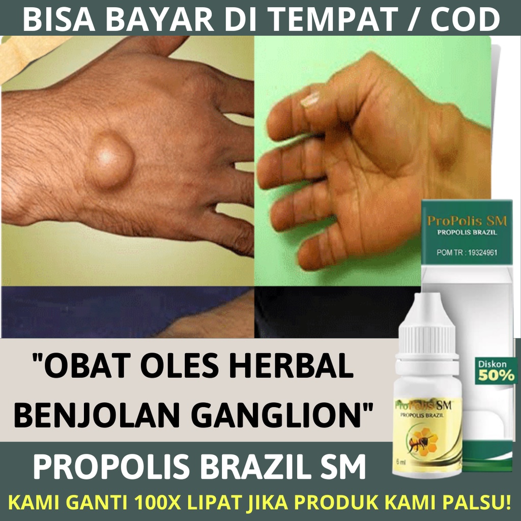 Jual Obat Oles Penghancur Benjolan Ganglion - Obat Benjolan Ganglion ...