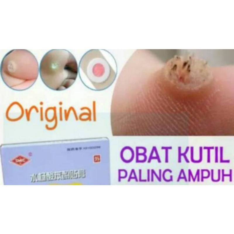 obat penghilang kutil