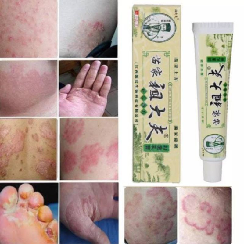 [ ORIGINAL ] Zudaifu Salep Gatal Penyakit Kulit Alergi Eksim Jamur Ruam Kemerahan Psoriasis Pruritus