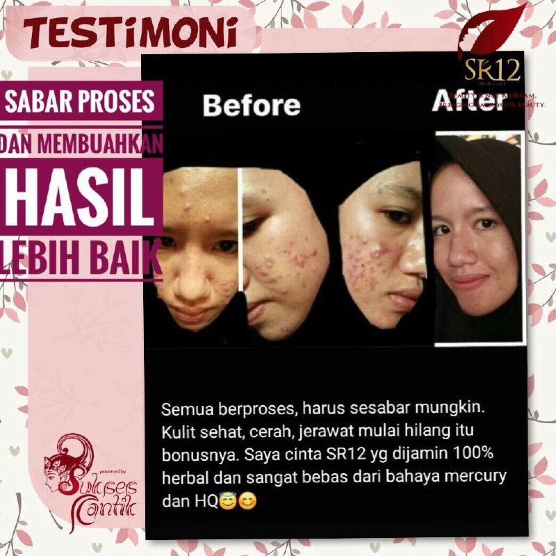 SERUM JERAWAT BPOM AMPUH..!! ACNE SERUM SR12 / OBAT PENGHILANG JERAWAT / SERUM RADANG JERAWAT