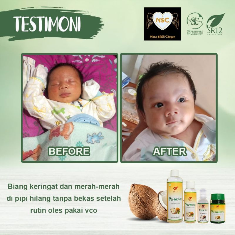 VCO Bayi - Obat Gatal Gatal - Biang Keringat - Ruam Popok Bayi - Obat Ruam Merah - VICO SR12 Minyak Kelapa 100% Herbal Aman BPOM