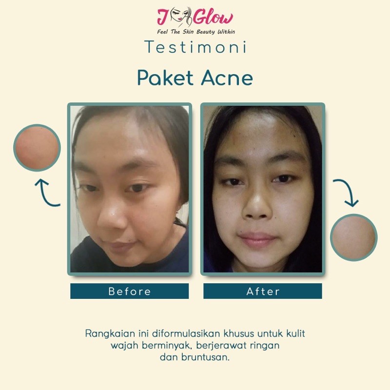 JGLOW SKINCARE ACNE + Acne Refine Serum